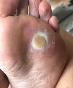 Compound W Maximum Strength One Step Plantar Wart Remover Foot Pads, 20 Count 20 Count (Pack of 1) 55 71kK42iJOPL