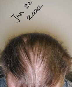 DHT BLOCKER - Hair Growth Supplement for Genetic Thinning for Men and Women | Approved* by American Hair Loss Association | Guaranteed, Backed by 20 Years of Experience in Hair Loss Treatment Clinics 57 71llBi8BmJL