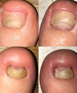 PURELY NORTHWEST-Tea Tree Oil & Peppermint Foot Soak with Epsom Salt-for Stubborn Foot Odor, Athletes Foot Burning & Itching, Damaged Discolored Nails-A Natural Callus Remover 16 Ounces 1 Pound (Pack of 1) 37 71m XlqHevL