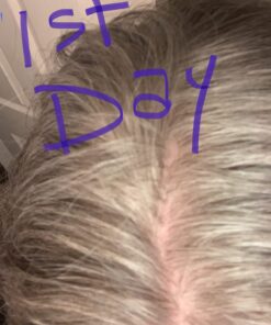 DHT BLOCKER - Hair Growth Supplement for Genetic Thinning for Men and Women | Approved* by American Hair Loss Association | Guaranteed, Backed by 20 Years of Experience in Hair Loss Treatment Clinics 49 71oPvz zbfL