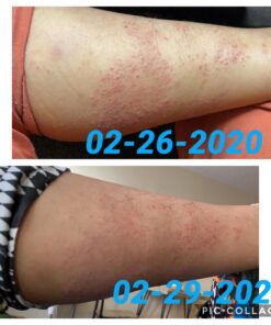 Eczema Cream for Adults & Kids - Eczema Psoriasis & Rosacea Care Cream for Dry Itchy Skin Relief - Face Body & Hand Eczema Moisturizer - Eczema Relief & Seborrheic Dermatitis Cream for Face 4 Ounce (Pack of 1) 26 71obDERLIrL 1