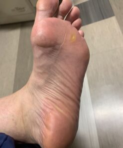 Dr. Scholl's Dual Action Freeze Away WART Remover, 8 Applications // Freeze Therapy + Powerful Fast Acting Salicylic Liquid to Remove Common and Plantar Warts, 0.33 Fl Oz, 1 Count 52 71p9qwhPVxL