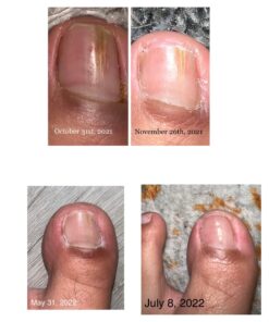 Toenail Renewal Solution Extra Strength Care for Toe Nail & Fingernails - Nail Repair Solution for Thick, broken, Discolored Nails - Renews Damaged Cracked Ingrown Toenail - Tea Tree Oil for Healthier and Extra Strength Nails - Made In USA 0.50 Fl Oz 45 71pZ KOg81L