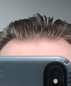 DHT BLOCKER - Hair Growth Supplement for Genetic Thinning for Men and Women | Approved* by American Hair Loss Association | Guaranteed, Backed by 20 Years of Experience in Hair Loss Treatment Clinics 67 71rGk Q8JHL