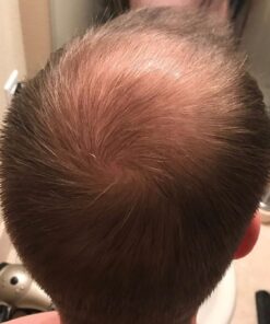 Men's Rogaine 5% Minoxidil Foam for Hair Loss and Hair Regrowth, Topical Treatment for Thinning Hair, 3-Month Supply, 2.11 Ounce (Pack of 3) Men's Rogaine Foam Treatment (3-Month Supply) 2.11 Ounce (Pack of 3) 47 71rWOueC9iL