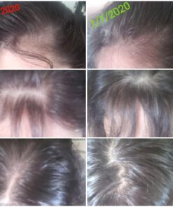 iRestore Essential Laser Hair Growth System - FDA Cleared Hair Loss Treatments for Men & Women & Hair Growth Products for Men with Thinning Hair, Hair Regrowth Treatments Laser Cap, Red Light Therapy 48 71sIi NX1xL