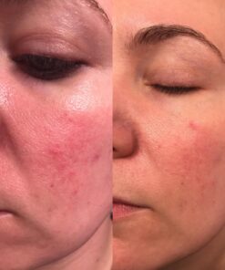 PUR360 Tamanu Oil - Best Treatment for Psoriasis, Eczema, Acne Scar, Rosacea - Relief for Dry, Scaly Skin, Scalp and More - Cold Pressed – Proven 100% Pure 36 71taWpZs7PL