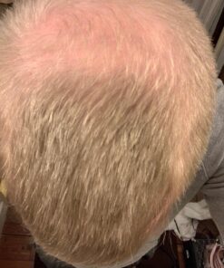 iRestore Essential Laser Hair Growth System - FDA Cleared Hair Loss Treatments for Men & Women & Hair Growth Products for Men with Thinning Hair, Hair Regrowth Treatments Laser Cap, Red Light Therapy 38 71tzEFm8ZcL