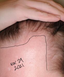 DHT BLOCKER - Hair Growth Supplement for Genetic Thinning for Men and Women | Approved* by American Hair Loss Association | Guaranteed, Backed by 20 Years of Experience in Hair Loss Treatment Clinics 58 71uK4flzfOL