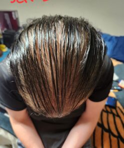 DHT BLOCKER - Hair Growth Supplement for Genetic Thinning for Men and Women | Approved* by American Hair Loss Association | Guaranteed, Backed by 20 Years of Experience in Hair Loss Treatment Clinics 59 71v5qq39 7L