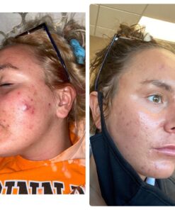 Obagi CLENZIderm M.D. Daily Care Foaming Acne Face Wash 4 Fl Oz (Pack of 1) 29 71xsrllSrOL