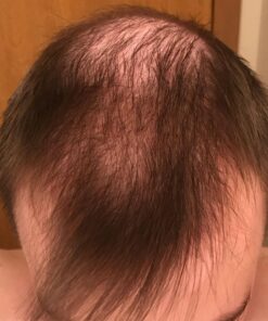 Men's Rogaine 5% Minoxidil Foam for Hair Loss and Hair Regrowth, Topical Treatment for Thinning Hair, 3-Month Supply, 2.11 Ounce (Pack of 3) Men's Rogaine Foam Treatment (3-Month Supply) 2.11 Ounce (Pack of 3) 48 71y9MwlOaL