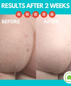 Green Heart Labs Butt Acne Clearing Lotion - Vegan & Cruelty-Free Treatment for Body, Back, Bum & Thigh - Clear Pimples, Bumps, Blackheads 4 Fl Oz (Pack of 1) 17 71zMnMwtGL