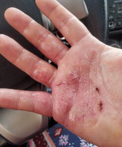 MG217 Multi Symptom Relief 2% Coal Tar Medicated Psoriasis Ointment oz Jar, 4 Oz 4 Ounce (Pack of 1) 38 813BmFNUWKL