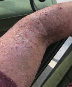 Psorclear-Psoriasis & Eczema Relief | A Proven Effective and All-Natural Product for Psoriasis Eczema & Rosacea Relief That Works - Rated One of The Best (120 Count Bottle) 19 814npYHKluL