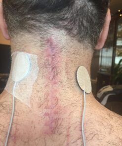 NewGel+E Advanced Silicone Scar Treatment Gel for OLD and NEW Scars w Vitamin E, for Surgery, Injury, Keloids, Burns, and Facial Blemish Scars (1 oz) 1 Ounce 25 818QTkalefL