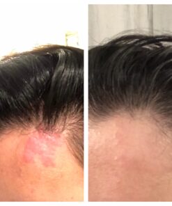 MG217 Multi Symptom Relief 2% Coal Tar Medicated Psoriasis Ointment oz Jar, 4 Oz 4 Ounce (Pack of 1) 47 81CCy7KkPpL