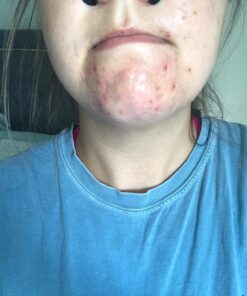 Obagi CLENZIderm M.D. Daily Care Foaming Acne Face Wash 4 Fl Oz (Pack of 1) 27 81CfwWZCfjL