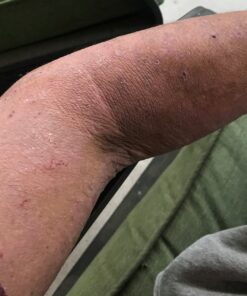 Psorclear-Psoriasis & Eczema Relief | A Proven Effective and All-Natural Product for Psoriasis Eczema & Rosacea Relief That Works - Rated One of The Best (120 Count Bottle) 20 81FMI 1aVeL