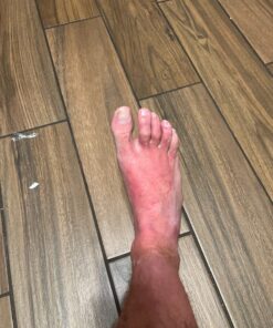 emuaid EMUAIDMAX Ointment 2oz - Eczema Cream. Maximum Strength Treatment. Use Max Strength for Athletes Foot, Psoriasis, Jock Itch, Anti Itch, Rash and Skin Yeast Infection. Standard Packaging 36 81FjxQsV1WL