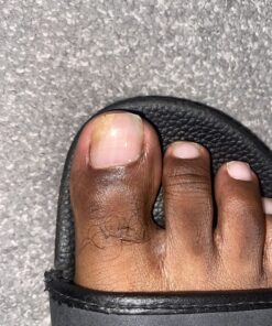 emuaid EMUAIDMAX Ointment 2oz - Eczema Cream. Maximum Strength Treatment. Use Max Strength for Athletes Foot, Psoriasis, Jock Itch, Anti Itch, Rash and Skin Yeast Infection. Standard Packaging 45 81G1YHGFe9L