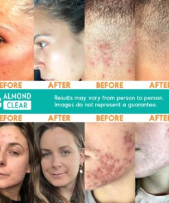 Face & Body Clearing Serum, Level 1- for acne, folliculitis, aging skin, ingrown hairs, dark spots - face, chest, butt, back, thighs, arms - mandelic acid - 1 fl oz 1 Fl Oz (Pack of 1) 19 81Jwv0PmTqL