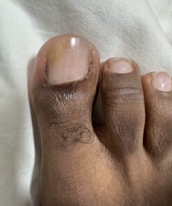 emuaid EMUAIDMAX Ointment 2oz - Eczema Cream. Maximum Strength Treatment. Use Max Strength for Athletes Foot, Psoriasis, Jock Itch, Anti Itch, Rash and Skin Yeast Infection. Standard Packaging 46 81KyYr2x3AL