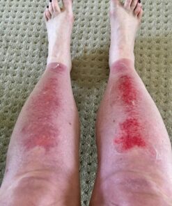 Structured Colloidal Silver Gel with Aloe Vera, for Burns, Wounds, Sores and Eczema - Strong Pure 30ppm pH Balanced 1 17 81MytUWmTbL