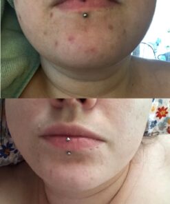 Keika Charcoal Black Soap Bar for Eczema, Psoriasis, Face, Body, Men Women Teens with Oily Skin, 5 oz. 5 Ounce (Pack of 1) 33 81Q9kqvvkeL