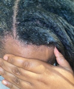 Nizoral Anti-Dandruff Shampoo with 1% Ketoconazole, Fresh Scent, 7 Fl Oz 57 81RU78NnaDL