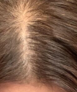 Pronexa Topical Hair Loss Serum by Hairgenics Stops Hair Loss and Accelerates Hair Growth and Hair Regrowth in Balding and Thinning Areas. 1 FL OZ. 33 81T6OjpqjGL