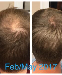 Men's Rogaine 5% Minoxidil Foam for Hair Loss and Hair Regrowth, Topical Treatment for Thinning Hair, 3-Month Supply, 2.11 Ounce (Pack of 3) Men's Rogaine Foam Treatment (3-Month Supply) 2.11 Ounce (Pack of 3) 41 81aZdd41tL