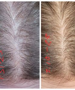 DHT BLOCKER - Hair Growth Supplement for Genetic Thinning for Men and Women | Approved* by American Hair Loss Association | Guaranteed, Backed by 20 Years of Experience in Hair Loss Treatment Clinics 42 81cBqTs9C3L