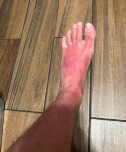 emuaid EMUAIDMAX Ointment 2oz - Eczema Cream. Maximum Strength Treatment. Use Max Strength for Athletes Foot, Psoriasis, Jock Itch, Anti Itch, Rash and Skin Yeast Infection. Standard Packaging 37 81fypbm24LL