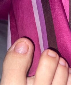 Toenail Renewal Solution Extra Strength Care for Toe Nail & Fingernails - Nail Repair Solution for Thick, broken, Discolored Nails - Renews Damaged Cracked Ingrown Toenail - Tea Tree Oil for Healthier and Extra Strength Nails - Made In USA 0.50 Fl Oz 51 81iI0zkJSOL