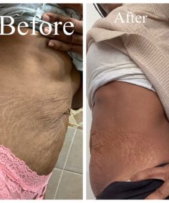 Eveline Slim Extreme 4D Liposuction Body Serum, Firming Body Lotion for Women and Men and Body Sculpting Cellulite Workout Cream 40 81pta0hpcL