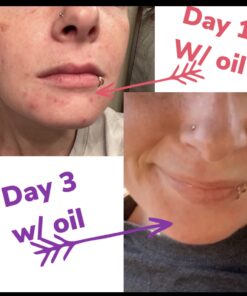 PUR360 Tamanu Oil - Best Treatment for Psoriasis, Eczema, Acne Scar, Rosacea - Relief for Dry, Scaly Skin, Scalp and More - Cold Pressed – Proven 100% Pure 33 81rCRI01VbL