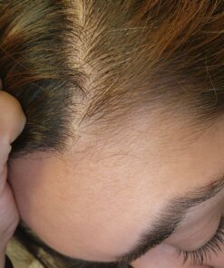 Nizoral Anti-Dandruff Shampoo with 1% Ketoconazole, Fresh Scent, 7 Fl Oz 56 81vD4D6cUOL