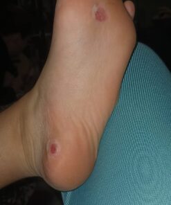 Compound W Maximum Strength One Step Plantar Wart Remover Foot Pads, 20 Count 20 Count (Pack of 1) 49 81xfS2RyxHL