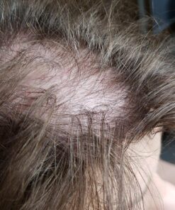 Pronexa Topical Hair Loss Serum by Hairgenics Stops Hair Loss and Accelerates Hair Growth and Hair Regrowth in Balding and Thinning Areas. 1 FL OZ. 31 81zhAU93LfL