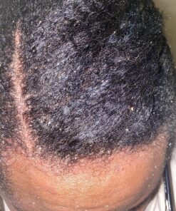 Nizoral Anti-Dandruff Shampoo with 1% Ketoconazole, Fresh Scent, 7 Fl Oz 59 910ukIi3efL