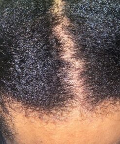 Nizoral Anti-Dandruff Shampoo with 1% Ketoconazole, Fresh Scent, 7 Fl Oz 60 91FBtoGINL