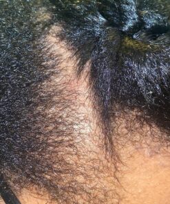 Nizoral Anti-Dandruff Shampoo with 1% Ketoconazole, Fresh Scent, 7 Fl Oz 61 91FDX9Sr7oL