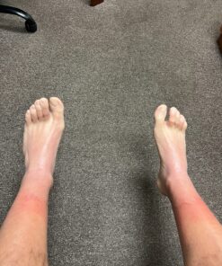 emuaid EMUAIDMAX Ointment 2oz - Eczema Cream. Maximum Strength Treatment. Use Max Strength for Athletes Foot, Psoriasis, Jock Itch, Anti Itch, Rash and Skin Yeast Infection. Standard Packaging 38 91H9To9XXqL