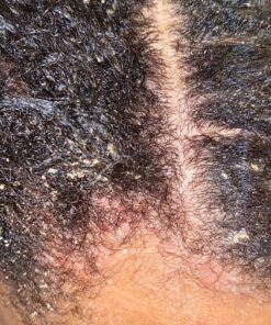 Nizoral Anti-Dandruff Shampoo with 1% Ketoconazole, Fresh Scent, 7 Fl Oz 62 91QIa1MtJQL