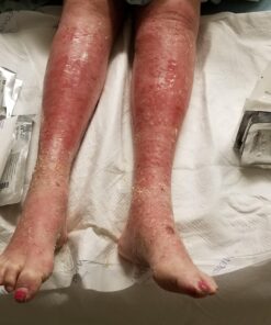 Psorclear-Psoriasis & Eczema Relief | A Proven Effective and All-Natural Product for Psoriasis Eczema & Rosacea Relief That Works - Rated One of The Best (120 Count Bottle) 22 91USXHMWxWL