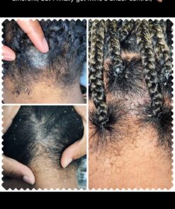 Dermasolve 4 oz Psoriasis, Seborrheic Dermatitis, & Dandruff Scalp Oil 2 Pack | Dermatologist Approved | Flaky Scalp Relief | Clinically Tested, Long-Lasting Itch-Free, High-Performance Formula 4 Ounce (Pack of 2) 26 91VZvTIqxmL