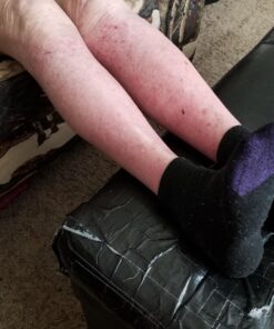 Psorclear-Psoriasis & Eczema Relief | A Proven Effective and All-Natural Product for Psoriasis Eczema & Rosacea Relief That Works - Rated One of The Best (120 Count Bottle) 23 91iSbqe4sNL