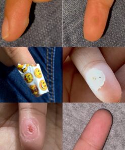 Compound W One Step Wart Remover Strips for Kids, 10 Medicated Strips for Wart Removal, 2 Pack unflavored 10 Count (Pack of 2) 52 A10Cwxb6ebL