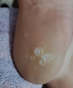 Compound W Maximum Strength One Step Plantar Wart Remover Foot Pads, 20 Count 20 Count (Pack of 1) 63 A1U5k2diSaL